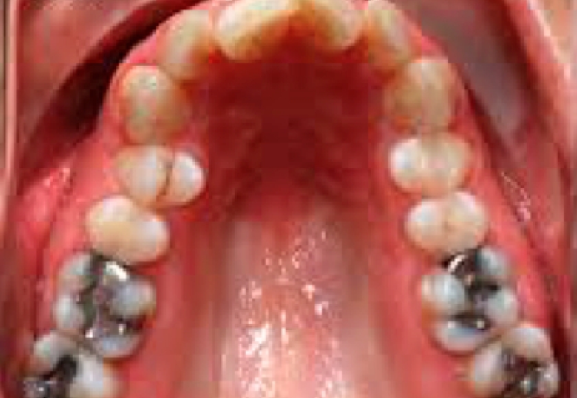 舌の機能不全がもたらす口蓋の問題と歯並び